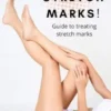 Bye Bye, Stretch Marks!