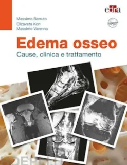 Edema osseo